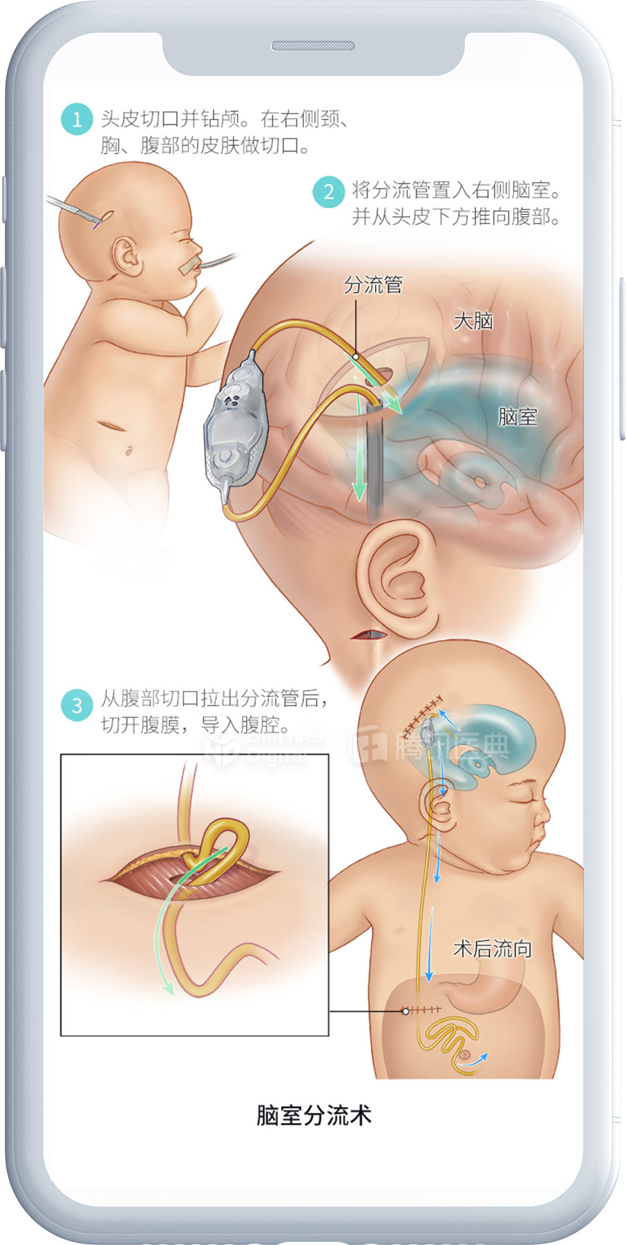 Medical illustration of ventriculoperitonial shunt