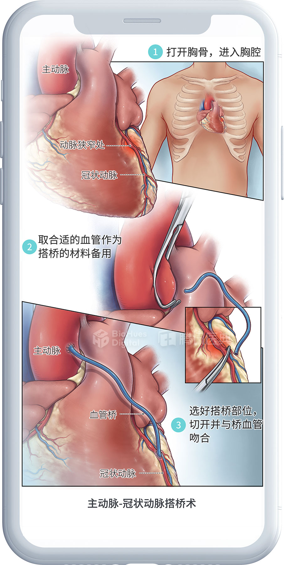 Medical illustration of coronary artery bypass surgery