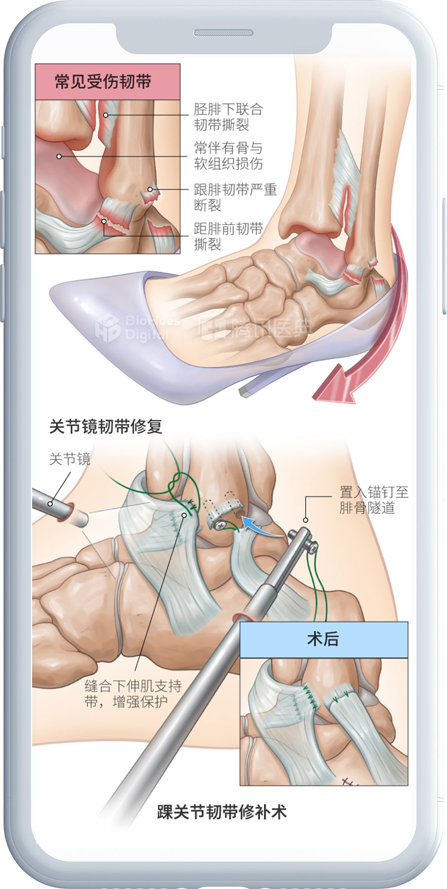 Medical illustration of ankle tendon repair surgery-biohues digital