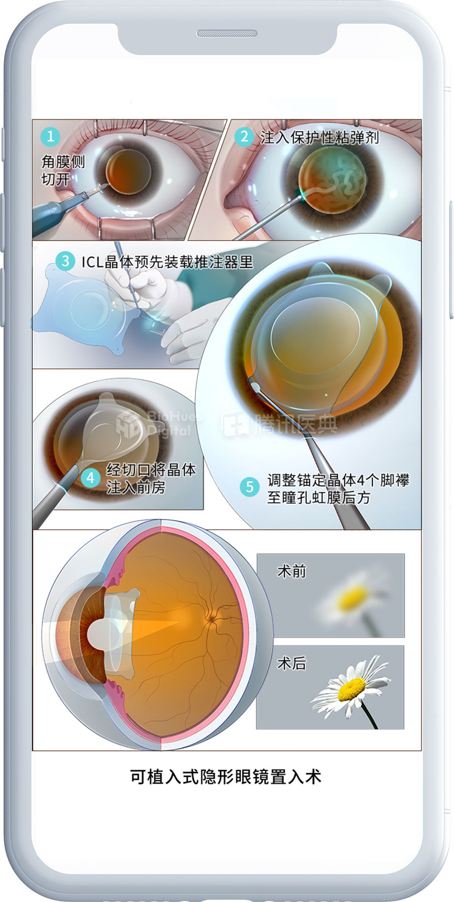 Medical illustration of contact lens implant surgery-biohues digital