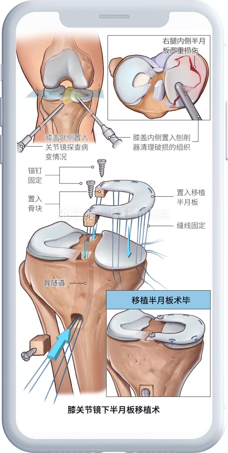 Medical illustration of transplant surgery of the meniscus-biohues digital