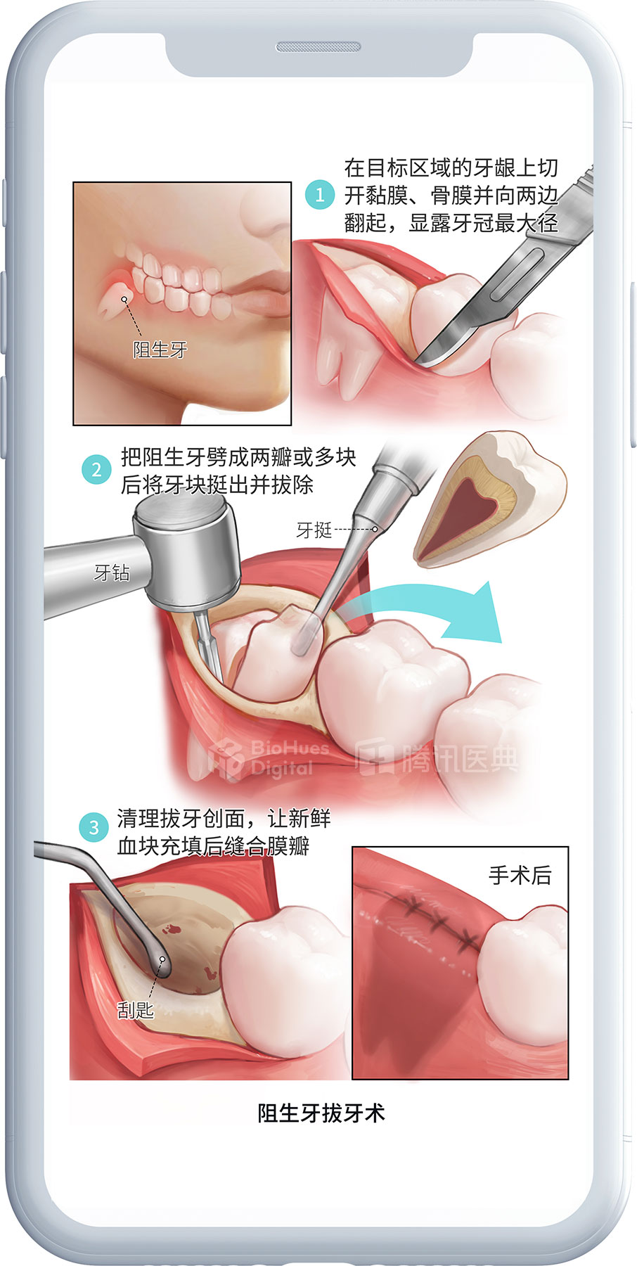 Medical illustration of wisdom tooth removal